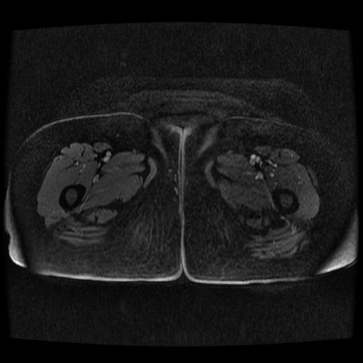 Cervical carcinoma (Radiopaedia 70924-81132 Axial T1 C+ fat sat 6).jpg