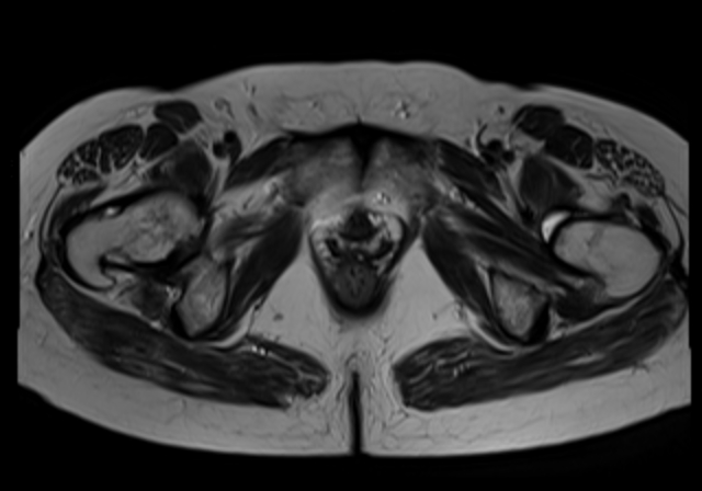 File:Cervical carcinoma (Radiopaedia 88312-104943 Sagittal T1 18).jpg