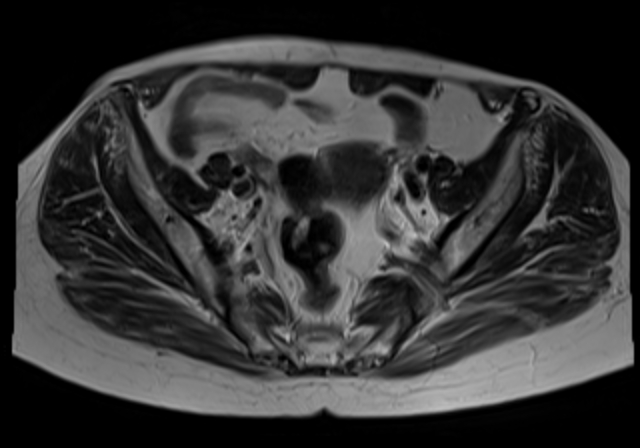 File:Cervical carcinoma (Radiopaedia 88312-104943 Sagittal T1 9).jpg