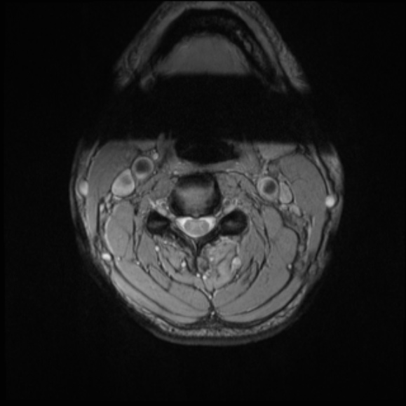 File:Cervical disc extrusion (Radiopaedia 53950-60077 Axial T2 11).jpg