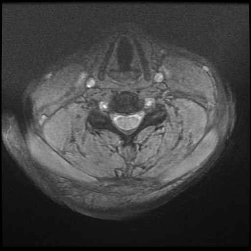 Cervical disc extrusion (Radiopaedia 59074-66364 F 28).jpg