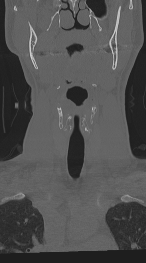 Cervical intercalary bone (Radiopaedia 35211-36748 Coronal bone window 14).png