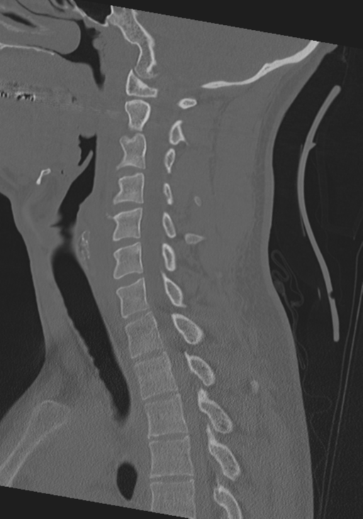 Cervical intercalary bone (Radiopaedia 35211-36748 Sagittal bone window 35).png