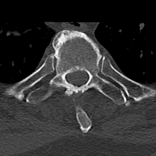 Cervical spine fracture - chalk stick (Radiopaedia 39116-41323 Axial bone window 102).png