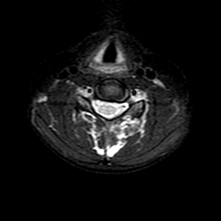 File:Cervical spine posterior ligamentous complex rupture (Radiopaedia 63486-72103 Axial T2 11).jpg