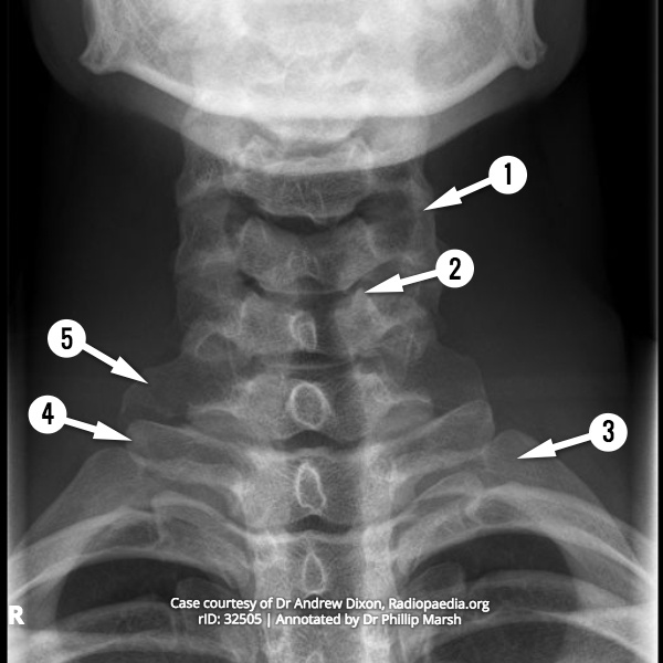 File:Cervical spine radiograph - AP (anatomy quiz) (Radiopaedia 62543).jpg