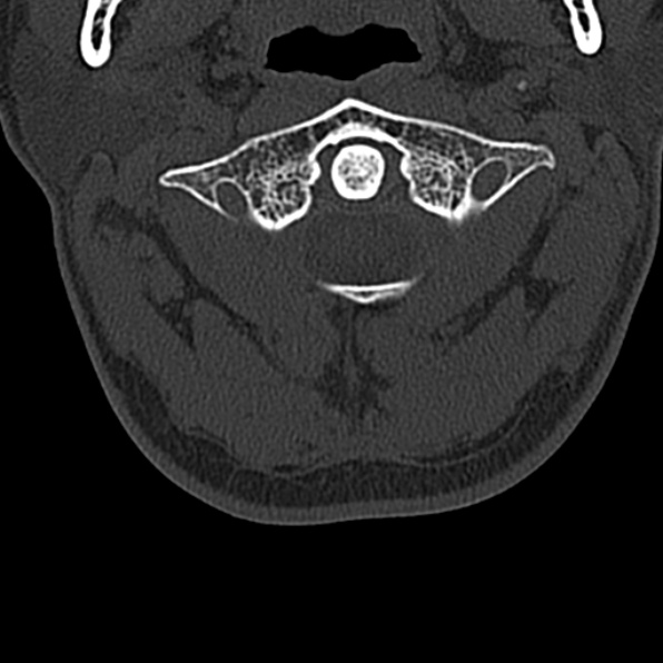 Cervical spondylodiscitis (Radiopaedia 28057-29489 Axial bone window 19).jpg
