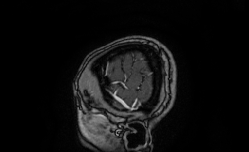 Cervical spondylodiscitis and calvarial hemangioma (Radiopaedia 64317-73103 Sagittal T1 C+ 4).jpg