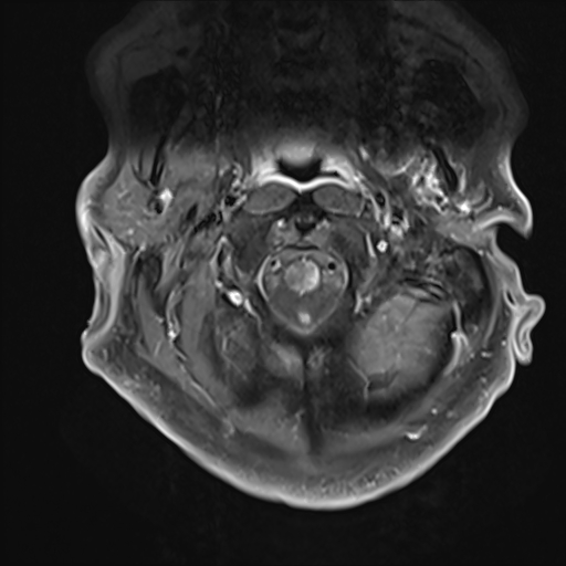 File:Cervical tumor-like myelopathy due to Type V dAVF (Radiopaedia 82461-96604 Axial T1 C+ fat sat 3).jpg