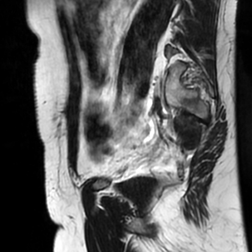 File:Cesarian section scar endometriosis (Radiopaedia 66520-75799 Sagittal T2 9).jpg