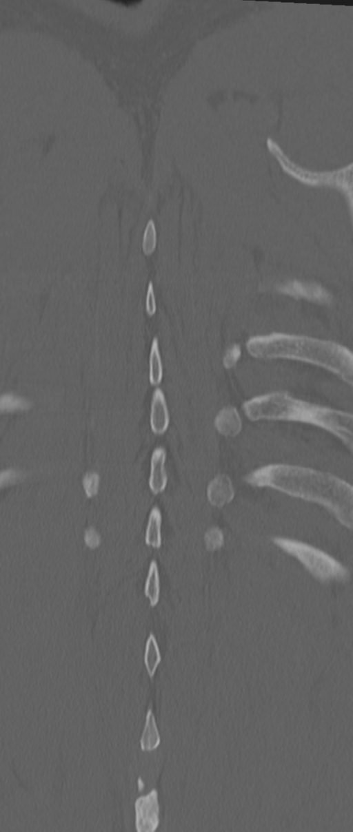 Chance fracture (Radiopaedia 33854-35020 Coronal bone window 77).png