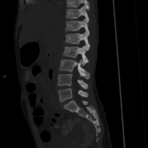 File:Chance fracture with duodenal and pancreatic lacerations (Radiopaedia 43477-50042 Sagittal bone window 14).jpg