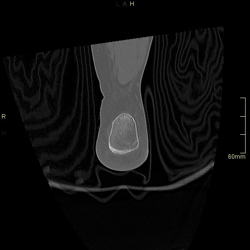 Chaput tubercle fracture (Radiopaedia 80319-93956 Coronal non-contrast 58).jpg