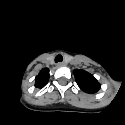 Chiari I with syrinx and skull base anomalies (Radiopaedia 89444-106412 Axial non-contrast 124).jpg