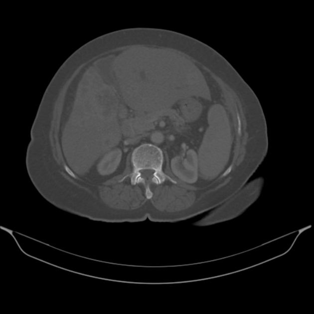 Cholangiocarcinoma (Radiopaedia 50592-56025 Axial bone window 30).jpg