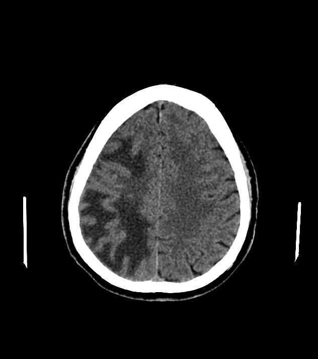 Cholangiocarcinoma with cerebral metastases (Radiopaedia 83519-98628 Axial non-contrast 49).jpg