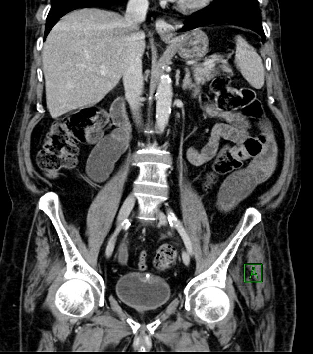 Cholangiocarcinoma with cerebral metastases (Radiopaedia 83519-98629 G 44).jpg