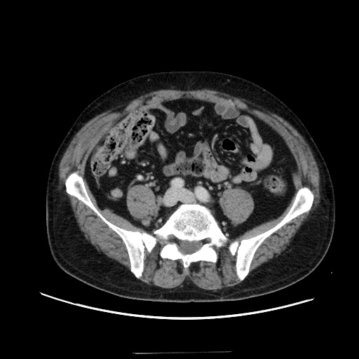 Choledocholiathiasis with normal caliber common bile duct (Radiopaedia 75368-86632 A 130).jpg