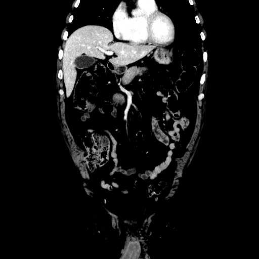 Choledocholiathiasis with normal caliber common bile duct (Radiopaedia 75368-86632 Coronal liver window 44).jpg