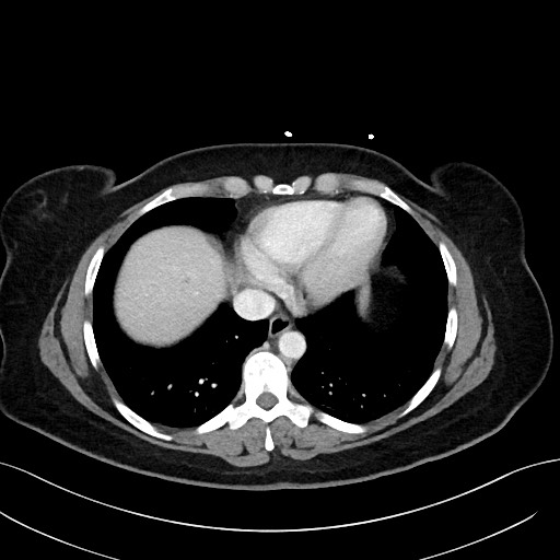 File:Choledocholithiasis after recent cholecystectomy (Radiopaedia 60929-68737 Axial 63).jpg