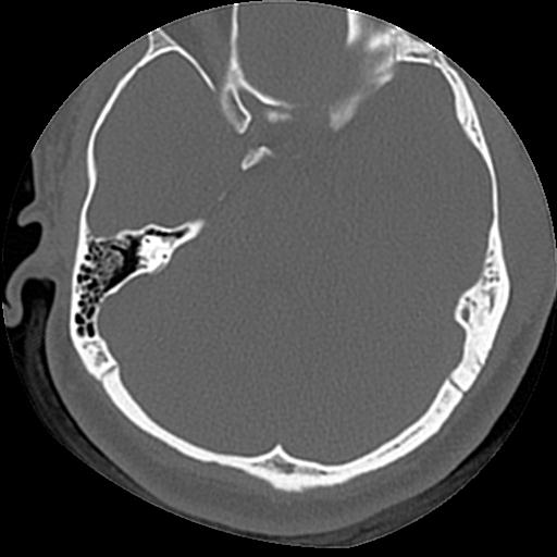 Cholesteatoma (Radiopaedia 84960-100474 Axial bone window 31).jpg