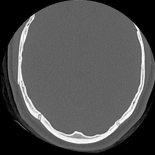Cholesteatoma (Radiopaedia 84960-100474 Axial bone window 8).jpg