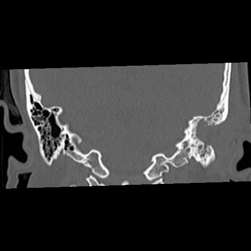File:Cholesteatoma (Radiopaedia 84960-100474 Coronal bone window 44).jpg