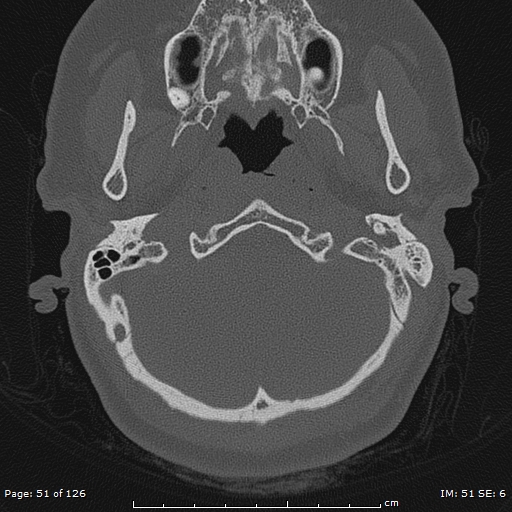 Cholesteatoma - external auditory canal (Radiopaedia 88452-105096 Axial bone window 14).jpg