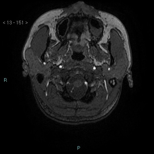 Cholesterol granuloma of the petrous apex (Radiopaedia 64358-73140 Axial TOF 3D 73).jpg