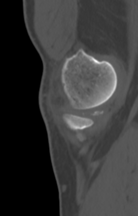 Chondrocalcinosis (Radiopaedia 82862-97173 Sagittal bone window 6).jpg