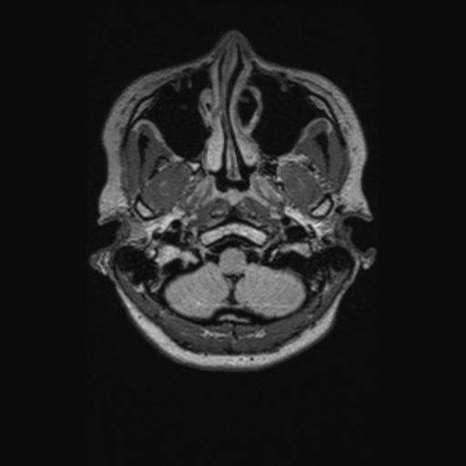 Chondrosarcoma (Radiopaedia 41937-44939 Axial FLAIR 16).png