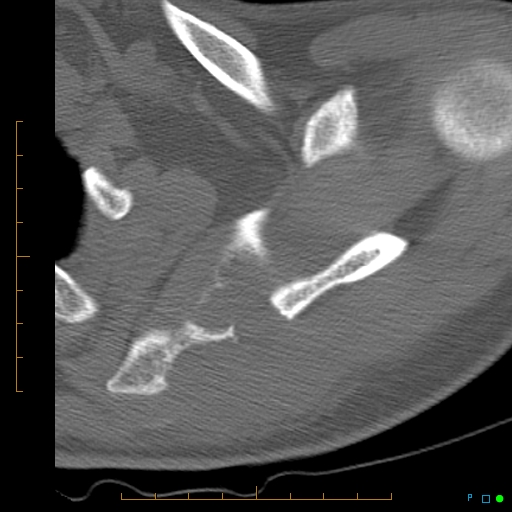 File:Chondrosarcoma of the scapula (Radiopaedia 30696-31399 Axial non-contrast 10).jpg