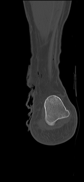 Chopart fracture (Radiopaedia 35347-36851 Coronal bone window 12).jpg