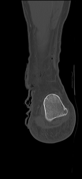 Chopart fracture (Radiopaedia 35347-36851 Coronal bone window 13).jpg