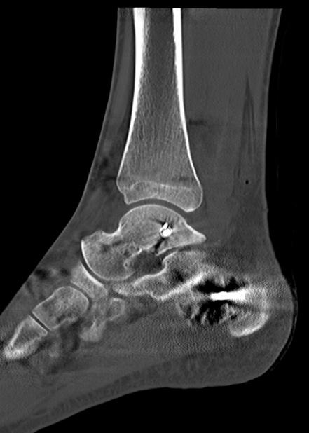 Chopart fracture (Radiopaedia 35347-36861 Sagittal bone window 43).jpg
