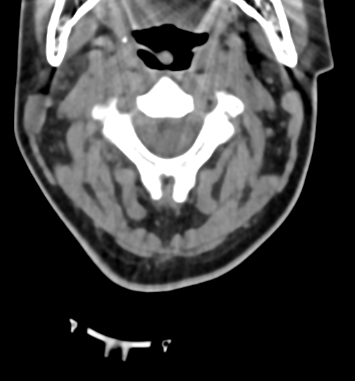 File:Chordoma (C4 vertebra) (Radiopaedia 47561-52188 Axial non-contrast 15).png