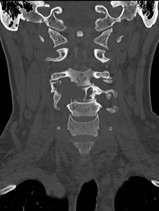 Chordoma (C4 vertebra) (Radiopaedia 47561-52188 Coronal bone window 20).png