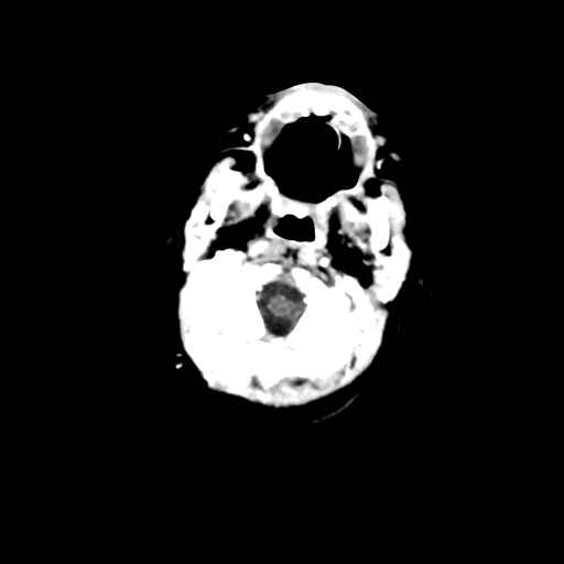 Choroid plexus papilloma (Radiopaedia 63946-72698 Axial with contrast 2).jpg