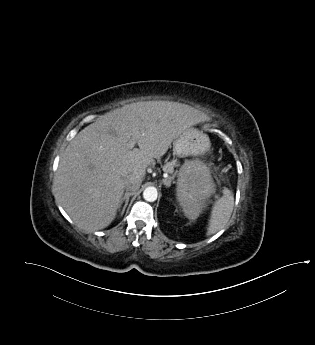 Chromophobe renal cell carcinoma (Radiopaedia 84239-99519 B 27).jpg