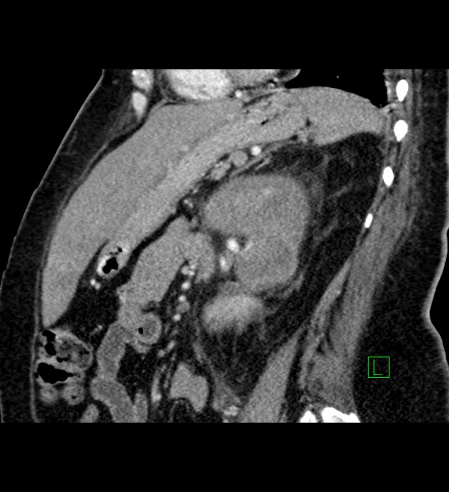 Chromophobe renal cell carcinoma (Radiopaedia 84239-99519 D 46).jpg
