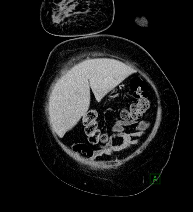 Chromophobe renal cell carcinoma (Radiopaedia 84239-99519 F 15).jpg