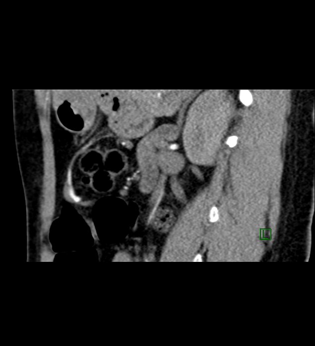 Chromophobe renal cell carcinoma (Radiopaedia 84290-99582 D 38).jpg