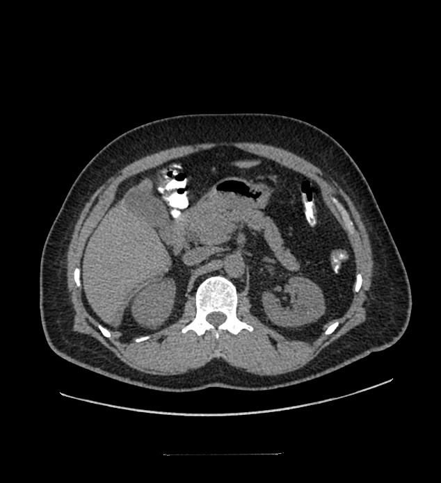 Chromophobe renal cell carcinoma (Radiopaedia 84337-99644 Axial non-contrast 33).jpg