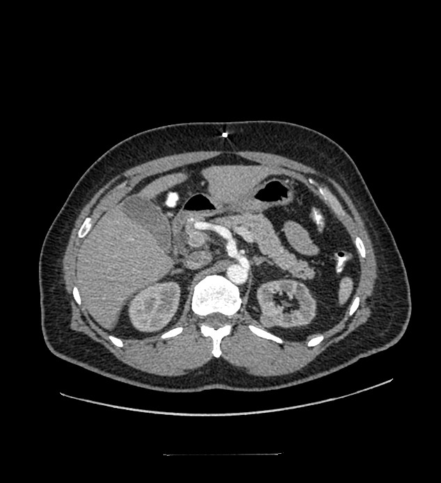 Chromophobe renal cell carcinoma (Radiopaedia 84337-99644 B 30).jpg