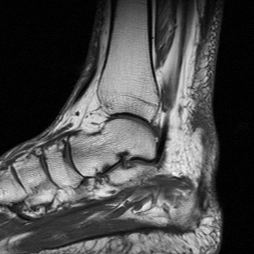 File:Chronic Achilles tendon rupture (Radiopaedia 15262-15100 Sagittal T1 9).jpg