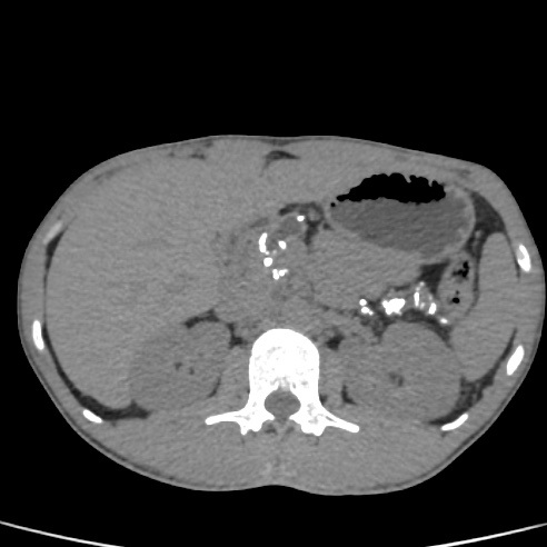 File:Chronic calcific pancreatitis (Radiopaedia 56280-62953 Axial non-contrast 14).jpg