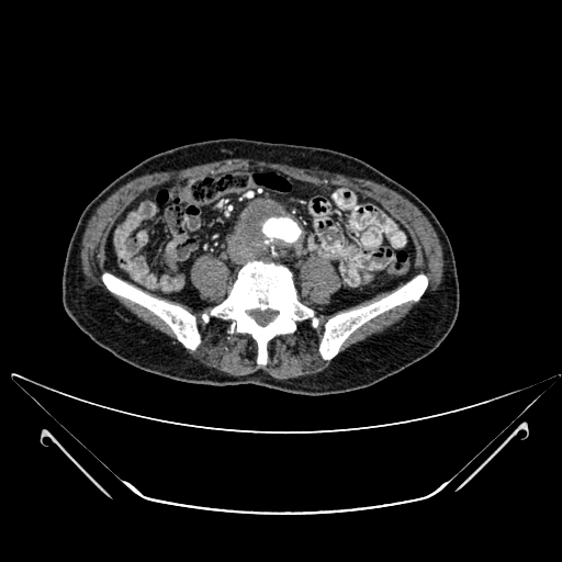 File:Chronic contained rupture of abdominal aortic aneurysm with extensive erosion of the vertebral bodies (Radiopaedia 55450-61901 A 44).jpg