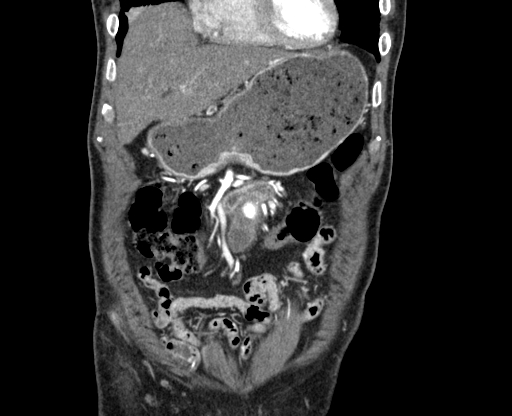 File:Chronic contained rupture of abdominal aortic aneurysm with extensive erosion of the vertebral bodies (Radiopaedia 55450-61901 D 7).jpg