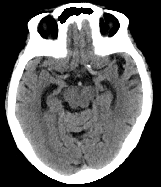 File:Chronic hypertensive encephalopathy (Radiopaedia 39993-42485 Axial non-contrast 14).png