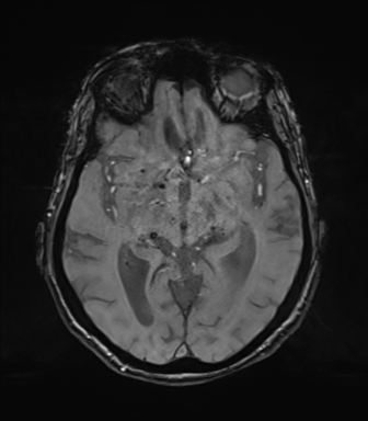 Chronic hypertensive encephalopathy (Radiopaedia 72844-83495 Axial SWI magnitude 37).png